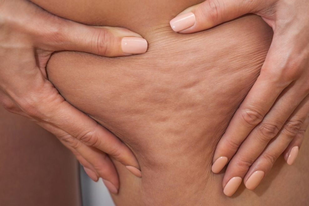 Anti-cellulite
