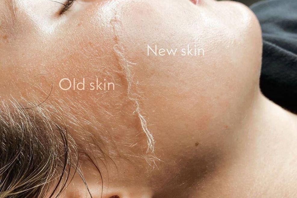 Dermaplaning