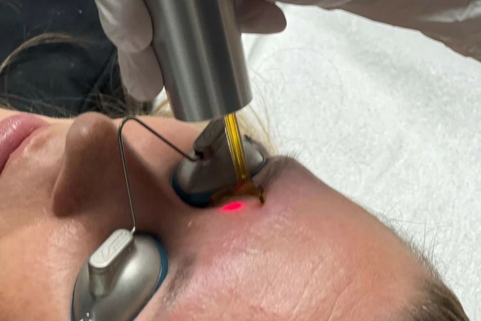 wenkbrauw Tattoo laseren