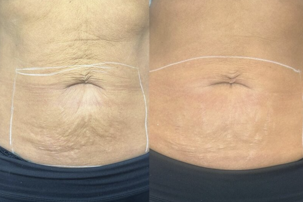 Inkless Stretch Mark Therapy treatment
